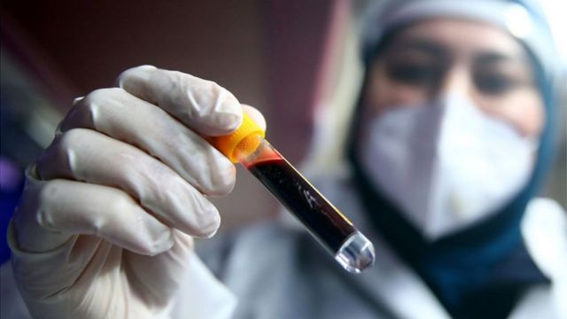 Azərbaycanda koronavirusa yoluxanların sayı azaldı – 30 nəfər öldü