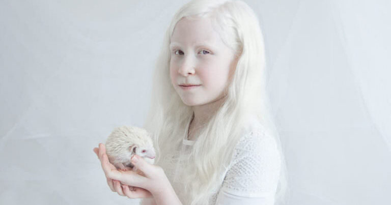 Albinos insanlar xəstə sayılır? – ÖZƏLLİKLƏRİ NƏLƏRDİR?